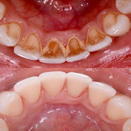 dental cleaning in sahakaranagar, dental scaling in sahakara nagar, teeth cleaning cost in apollo, teeth cleaning and polishing in sahakara nagar, teeth cleaning doctors in sahakara nagar, teeth cleaning in sahakara nagar, teeth polishing in sahakara nagar