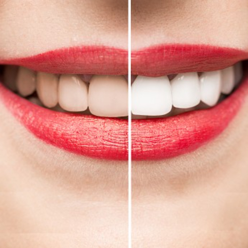 Teeth Whitening, dentist whitening cost, laser teeth whitening in sahakara nagar, teeth bleaching dentist, teeth whitening clinic in sahakara nagar, teeth whitening dentist, teeth whitening dentist cost, teeth whitening in sahakara nagar, teeth whitening service in sahakaranagar